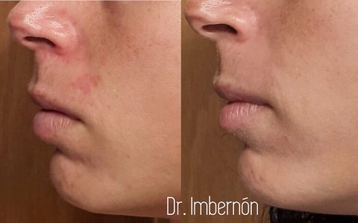 Rosácea - Síntomas clínicos